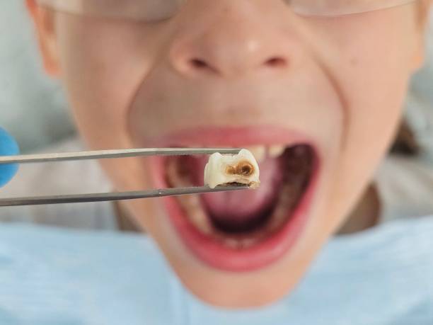 Best Emergency Root Canal Treatment in Red Lick, TX